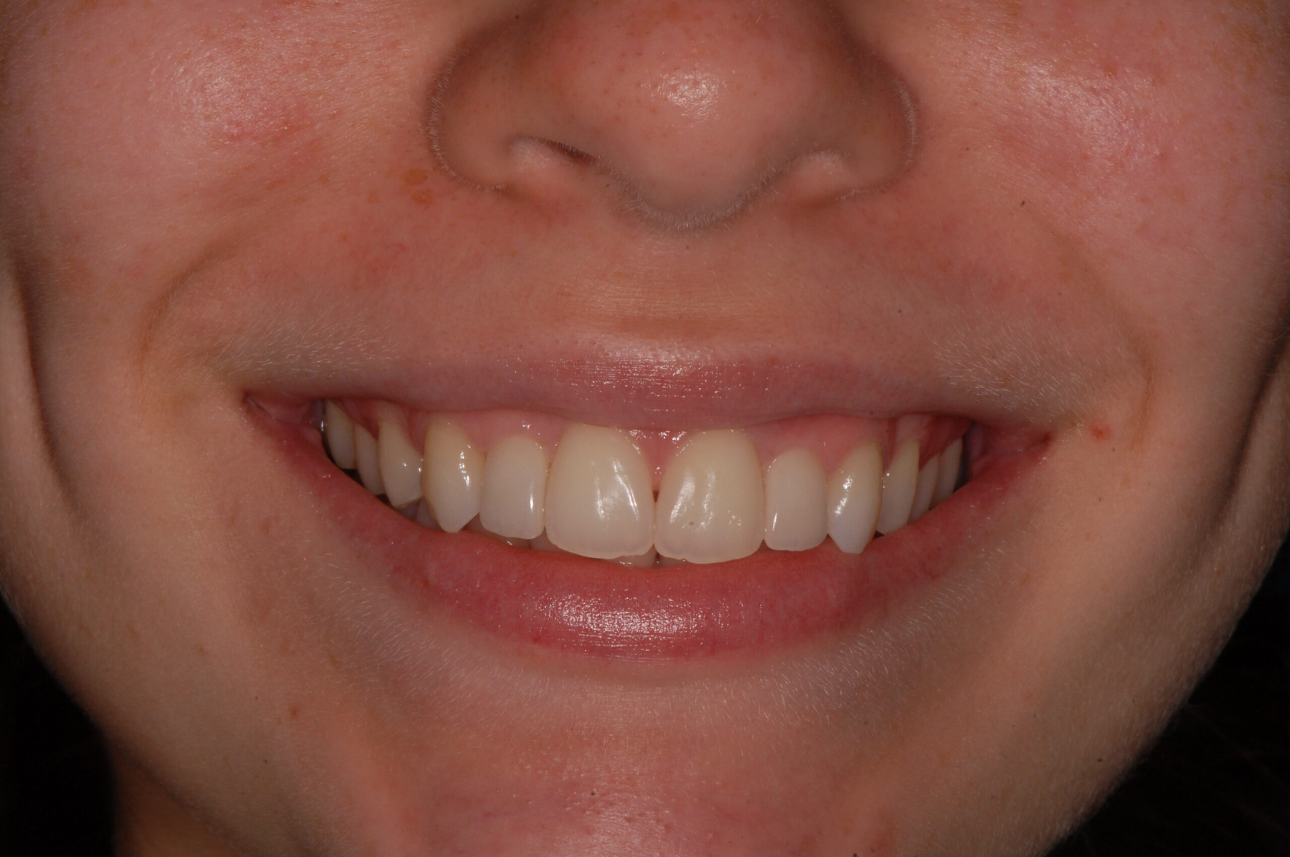 After smile