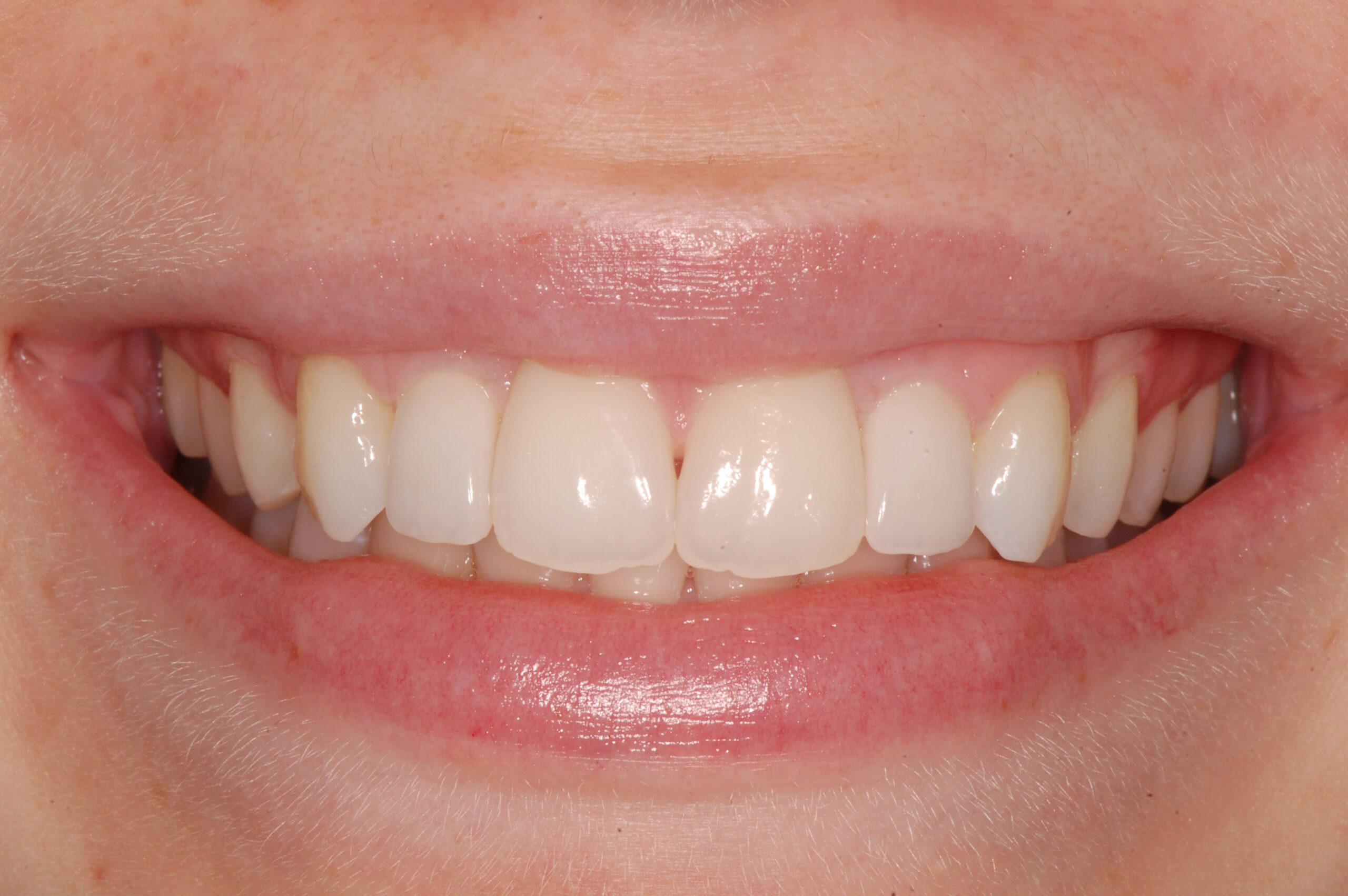 After smile